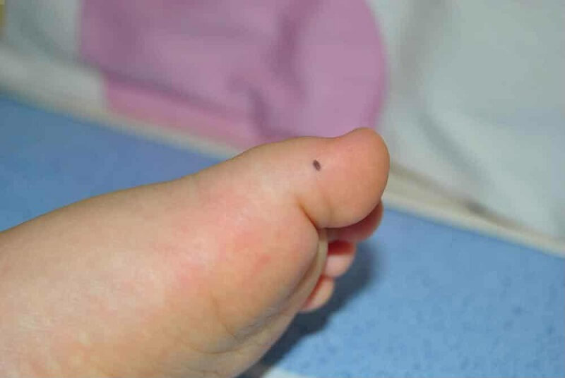 Nốt ruồi ở ngón chân cái Đàn ông, Phụ nữ có ý nghĩa gì? Bói chuẩn 99%
