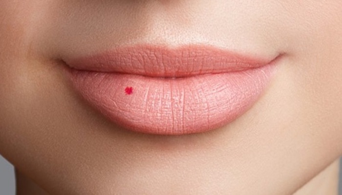 Nốt ruồi son ở môi trên môi dưới của nam nữ có ý nghĩa gì