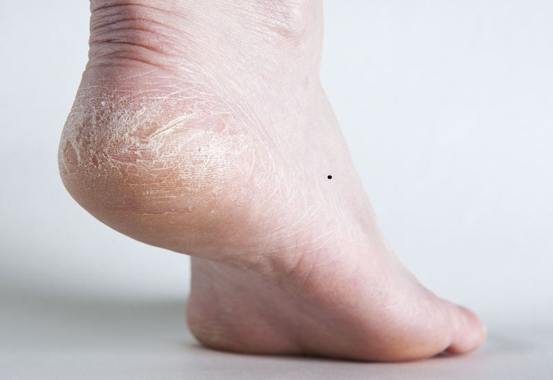 Giải mã nốt ruồi ở mép ngoài bàn chân phải nam