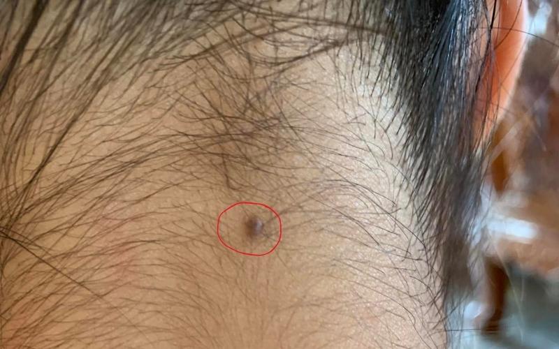 Nốt ruồi sau gáy trong tóc phụ nữ