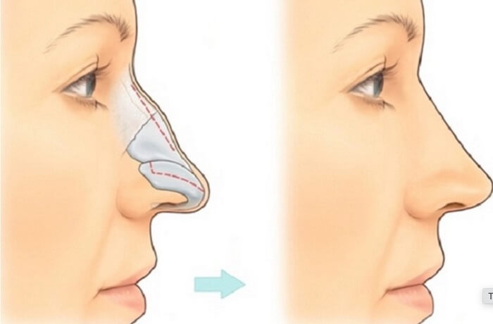 Mũi gãy có đặc điểm phần sống mũi không thẳng, đứt đoạn, gồ ghề1