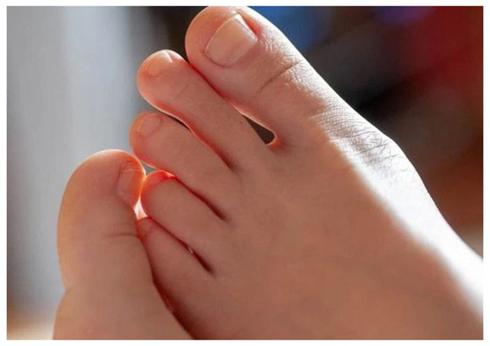 Ngón chân trỏ dài hơn ngón cái mang có ảnh hưởng đến sức khỏe?