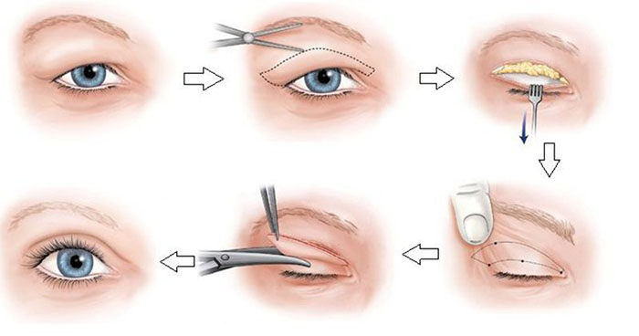 Phương pháp khắc phục mắt tứ bạch